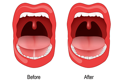 Ankyloglossia (tongue-tie) - Children's Health