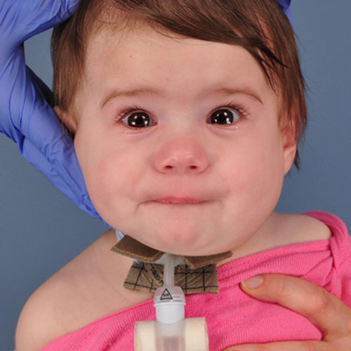 Un bebé después de la extracción de una malformación vascular 