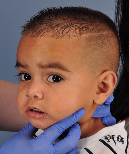 foto de un niño pequeño después de la extracción de un hemangioma