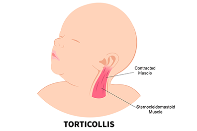 Torticollis in children - Children's Health