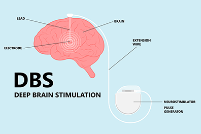 ECP (estimulación cerebral profunda) pediátrica: Children's Health