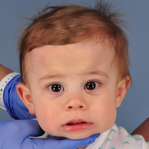 bebé con craneosinostosis metópica antes de la craniectomía de franja ósea