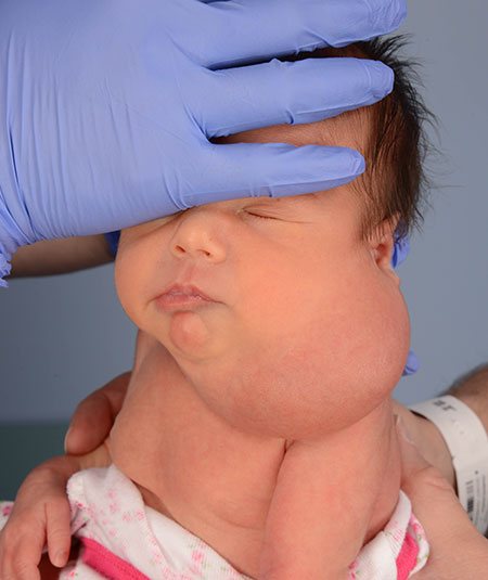 un bebé antes de la extracción de una malformación vascular