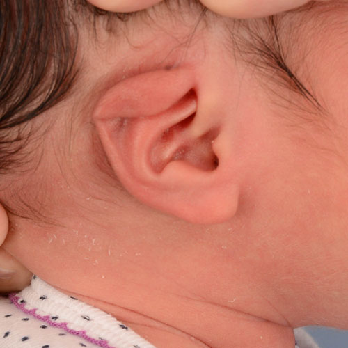 oreja de un bebé antes del tratamiento de reconstrucción y moldeado de orejas