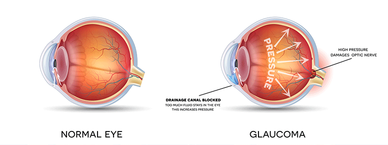 Glaucoma pediátrico: Children's Health