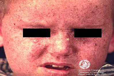 rostro de niño con xerodermia pigmentosa