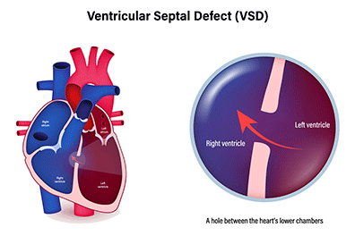 CIV (comunicación interventricular): Children's Health