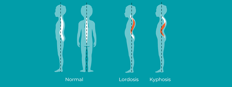Lordosis (swayback) and kyphosis in children - Children's Health