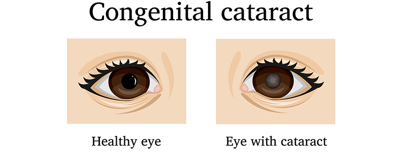 Contenital cataracts - Children's Health