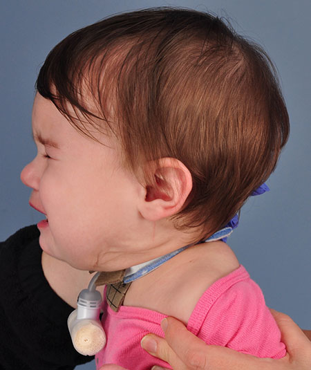 un bebé después de la extracción de una malformación vascular