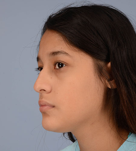 una niña antes de una rinoplastia para corregir un traumatismo nasal