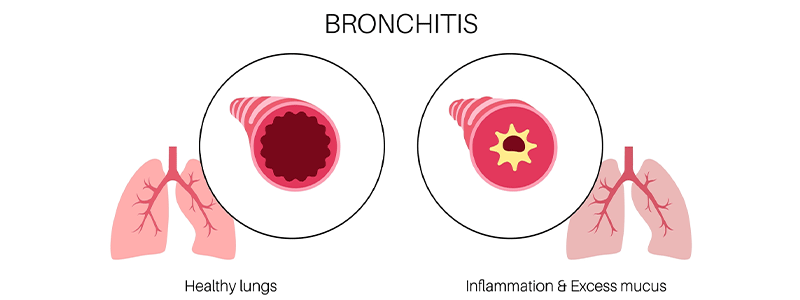 Pediatric bronchitis - Children's Health