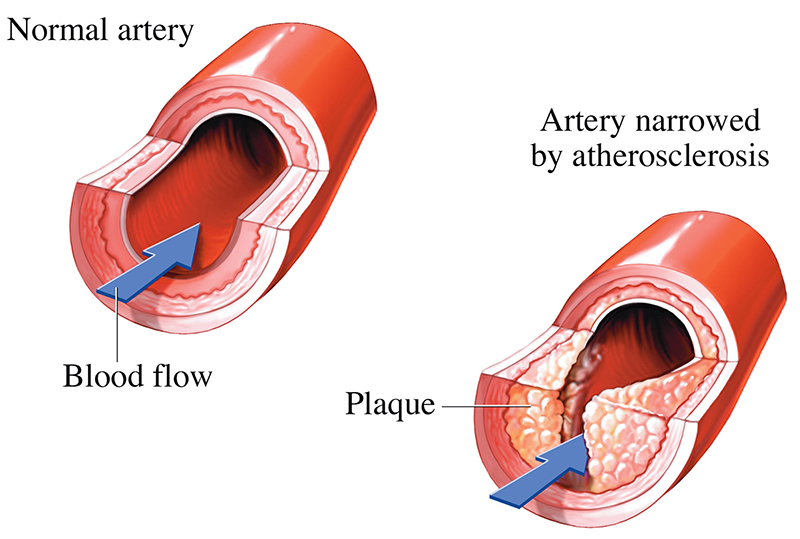 arteria normal y arteria estrechada por ateroesclerosis