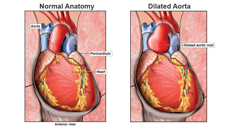 aorta normal, aorta dilatada y aorta corregida