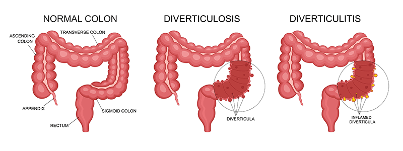 Diverticulitis - Children's Health