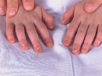 dedos de la mano de un niño con distrofia de las 20 uñas