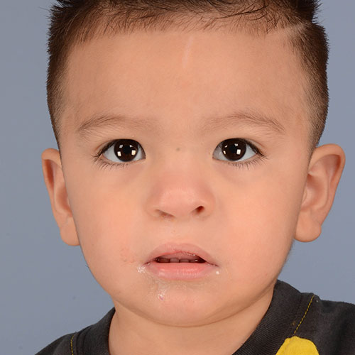 foto de un niño después de recibir tratamiento para labio leporino