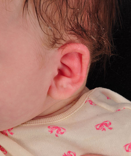 un bebé después de recibir tratamiento de moldeado por orejas constreñidas