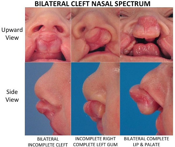 Imágenes que muestran el espectro del nivel de gravedad que tiene el labio leporino bilateral en la nariz