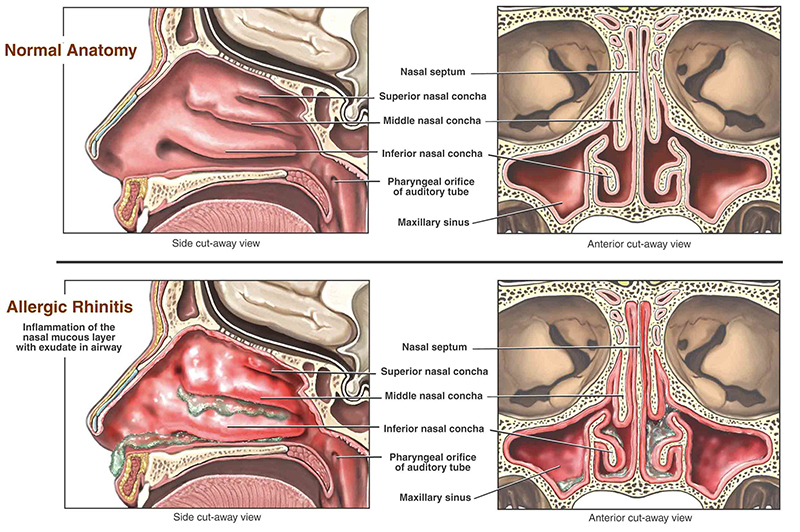 rinitis alérgica: ilustración del interior de la cavidad nasal
