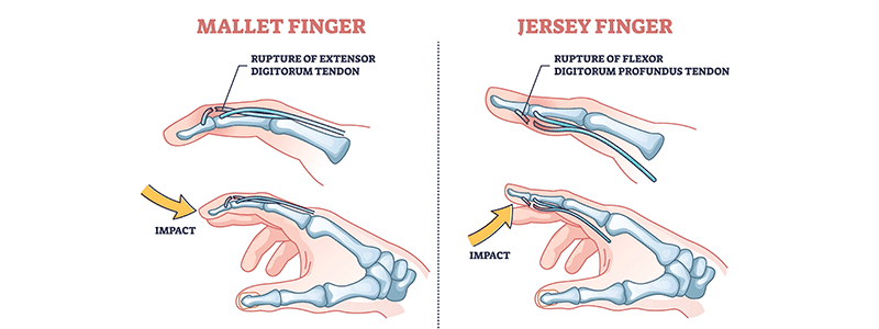 Mallet Finger and Jersey Finger - Children's Health
