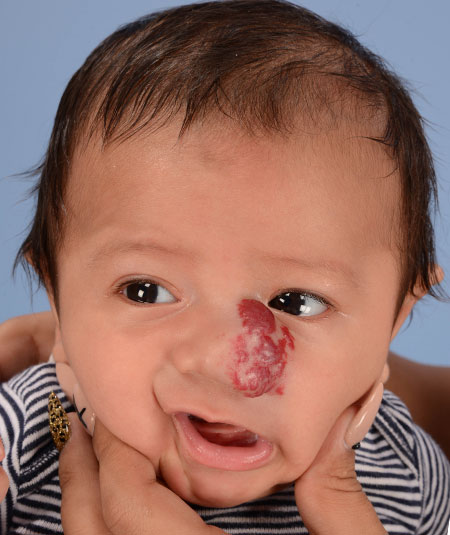 foto de un bebé con hemangioma en la nariz antes del tratamiento