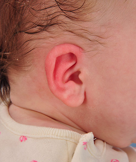 un bebé después de recibir tratamiento de moldeado por orejas constreñidas