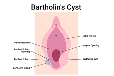 Bartholin's Gland Cyst - Children's Health