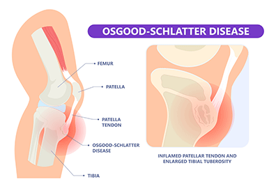 pediatric Osgood-Schlatter disease (OSD) - Children's Health