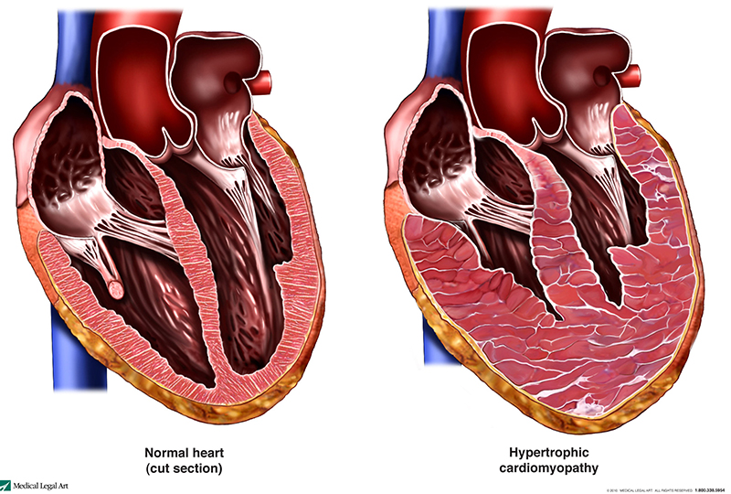 un corazón normal en comparación con un corazón con miocardiopatía hipertrófica