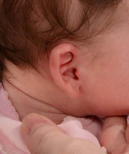 un bebé con orejas constreñidas antes del tratamiento de moldeado de orejas