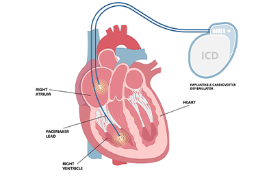 DCI (desfibrilador cardioversor implantable) pediátrico: Children's Health