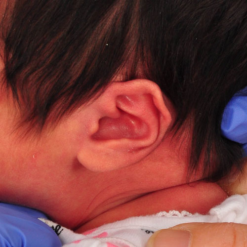 un bebé con pliegue helicoidal antes del tratamiento de moldeado de orejas