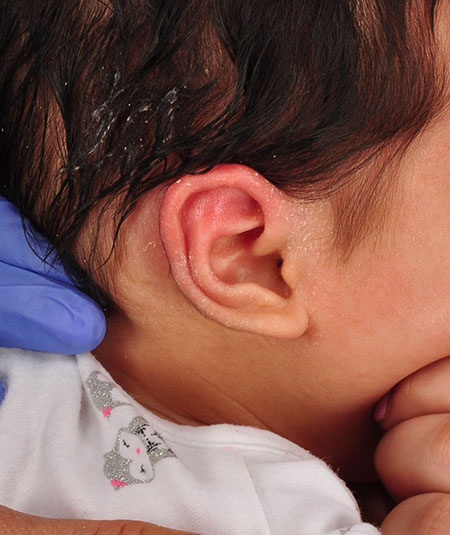 un bebé después de recibir tratamiento de moldeado por pliegue helicoidal en la oreja