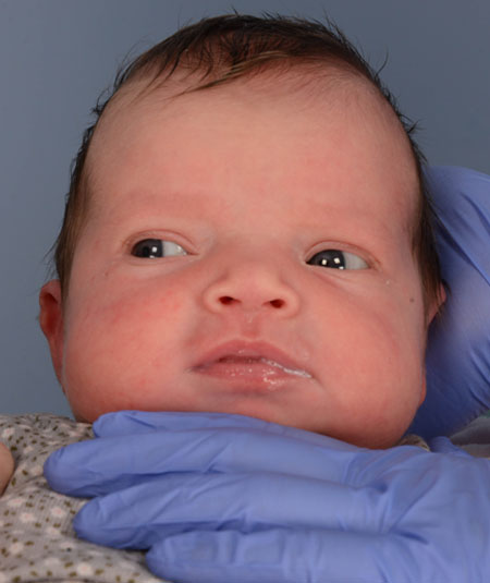 foto de una bebé con craneosinostosis sagital de franja ósea antes de recibir tratamiento en Children's Health