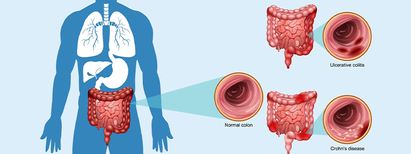 Pediatric inflammatory bowel disease (IBD) - Children's Health