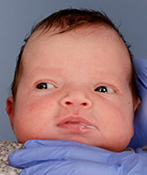 foto del antes de un bebé con craneosinostosis