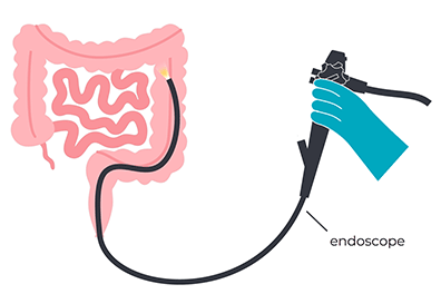 Pediatric colonoscopy - Children's Health