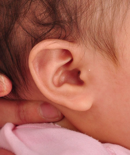 oreja de un bebé después del modelado
