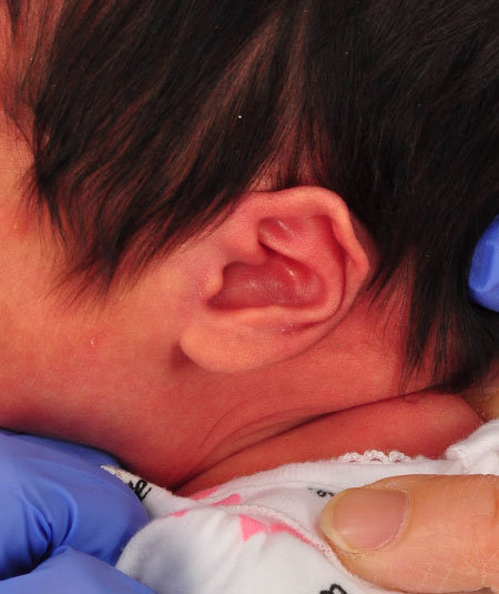 un bebé con pliegue helicoidal en la oreja antes del tratamiento de moldeado