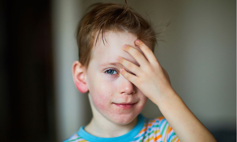 Niño pequeño con un sarpullido alérgico en la cara