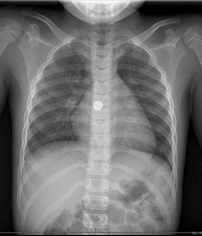 radiografía de tórax de una persona que comió una moneda