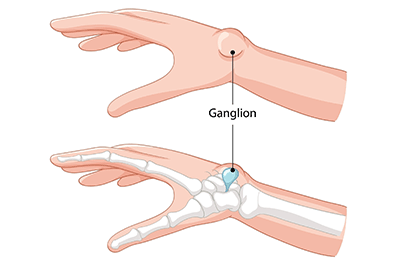 Ganglion cyst - Children's Health