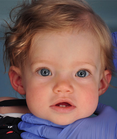 foto de una bebé con craneosinostosis sagital de franja ósea después de recibir tratamiento en Children's Health