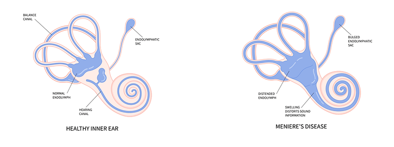 Pediatric Meniere's Disease - Children's Health