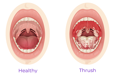 Candidiasis bucal (infección por cándida bucal) pediátrica: Children's Health