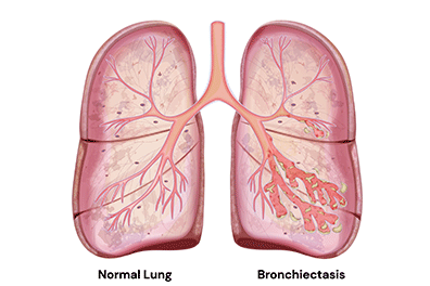 Bronchiectasis illistration - Children's Health
