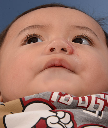 foto de un niño después de la extracción de un hemangioma
