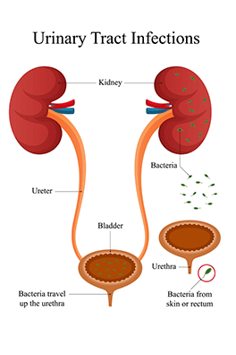 Pediatric urinary tract infection (UTI) - Children's Health